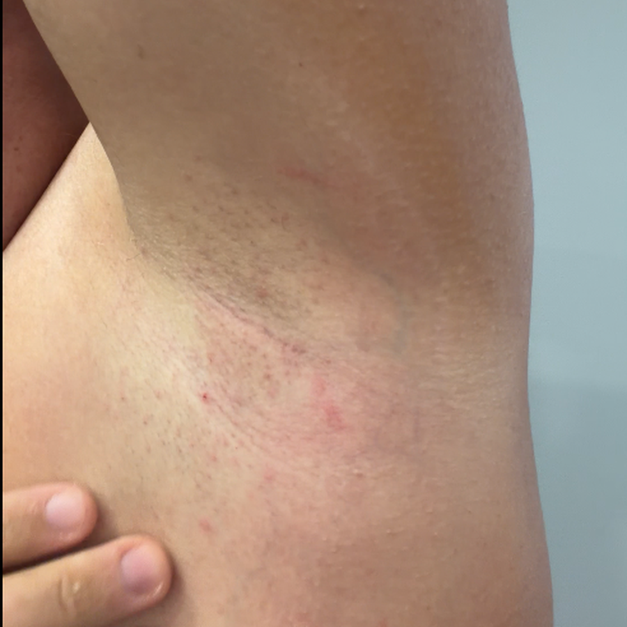 Underarm with red irritated bumps before switching to MAGS Skin