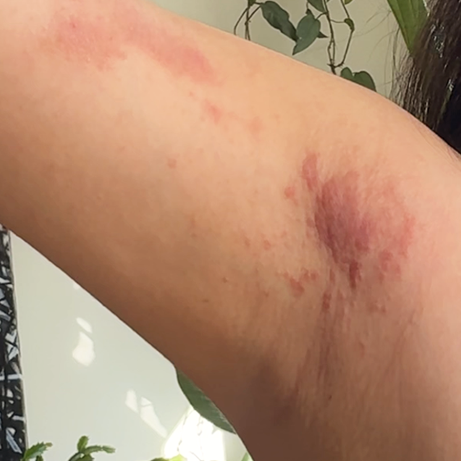 Underarm with visible redness and irritation while using other deodorants